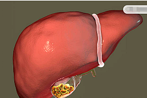 青少年得胆囊炎的原因