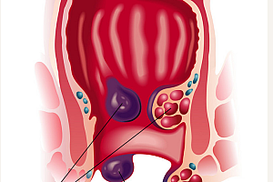 痔疮术后三大注意-痔疮手术后卧床几天拉屎不痛