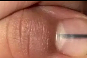 指甲上有黑色竖纹图片