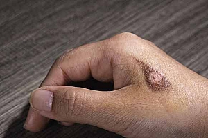 不小心烫伤了怎么处理-烫伤以后怎么办