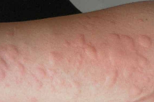 什么是过敏性疾病?