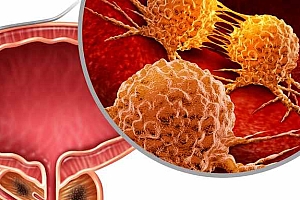 如何判断患了痔