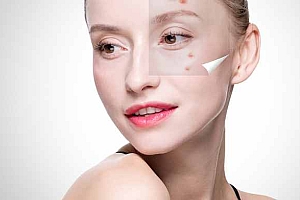 为什么青春痘夏天很严重-什么叫夏季青春痘