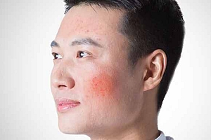 青春痘痤疮如何治疗-针对聚合性青春痘应如何进行局部处理