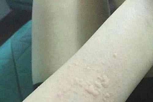 常见的尊麻疹类型有哪些-荨麻疹的类型有哪些