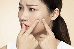 脸上长痘痘应该注意些什么-为避免青春痘瘢痕形成,我们在日常生活中应注意什么