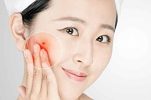 克林霉素好还是阿奇霉素好-阿奇霉素和克林挥素治疗青春痘效果如何