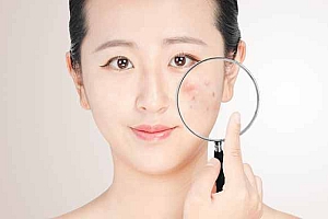 西咪替丁治疗痤疮用法-为什么西咪替丁能治青春痘