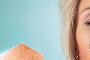 有治疗痘痘的药吗-系统治疗反常性青春痘,可选哪些药物