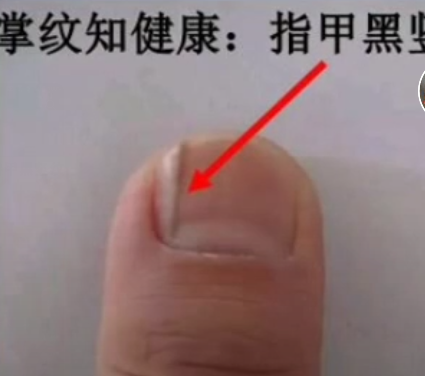 大拇指有黑色竖纹图片