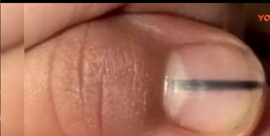 大拇指有黑色竖纹图片